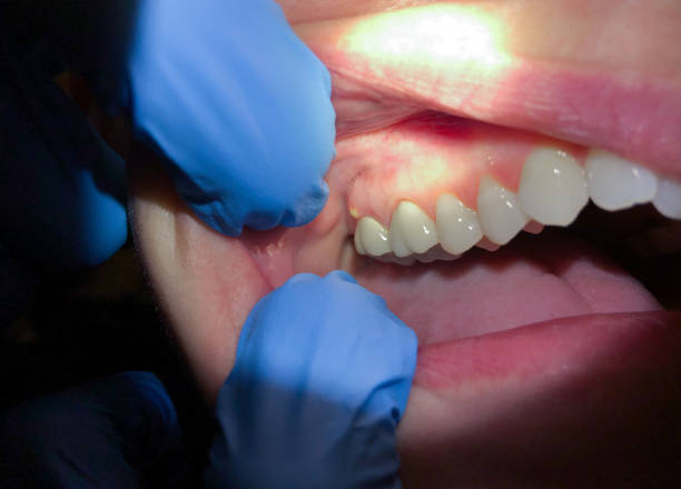 Best Emergency Treatment for Toothache in Ellijay, GA